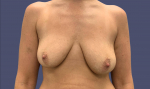 Breast Reduction with Augmentation 2 Before